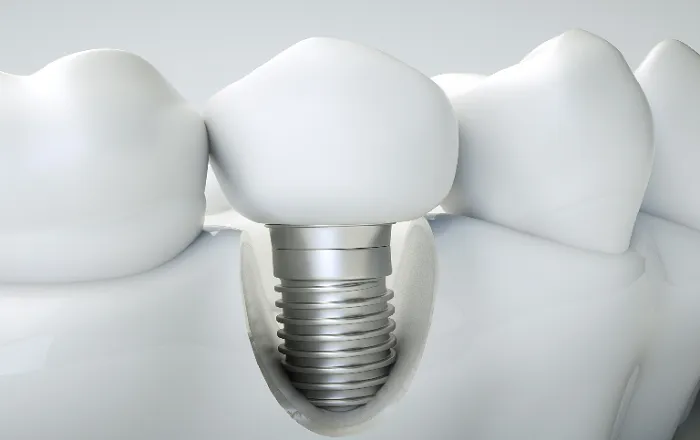 【Giải Đáp】Bao Nhiêu Tuổi Thì Trồng Răng Implant Được An Toàn?