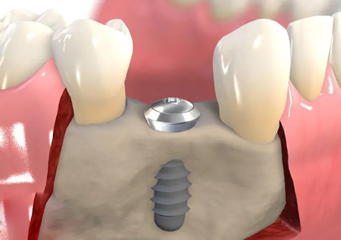 Độ tuổi nào thích hợp trồng răng implant? 2