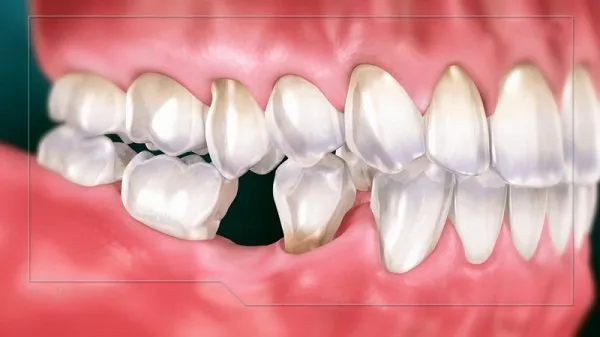 Mất răng số 6, mất răng hàm lâu năm có thể cấy ghép implant không? | Vinmec